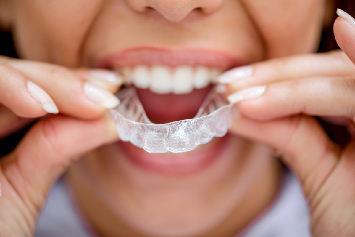 Invisalign for adults Glen Allen