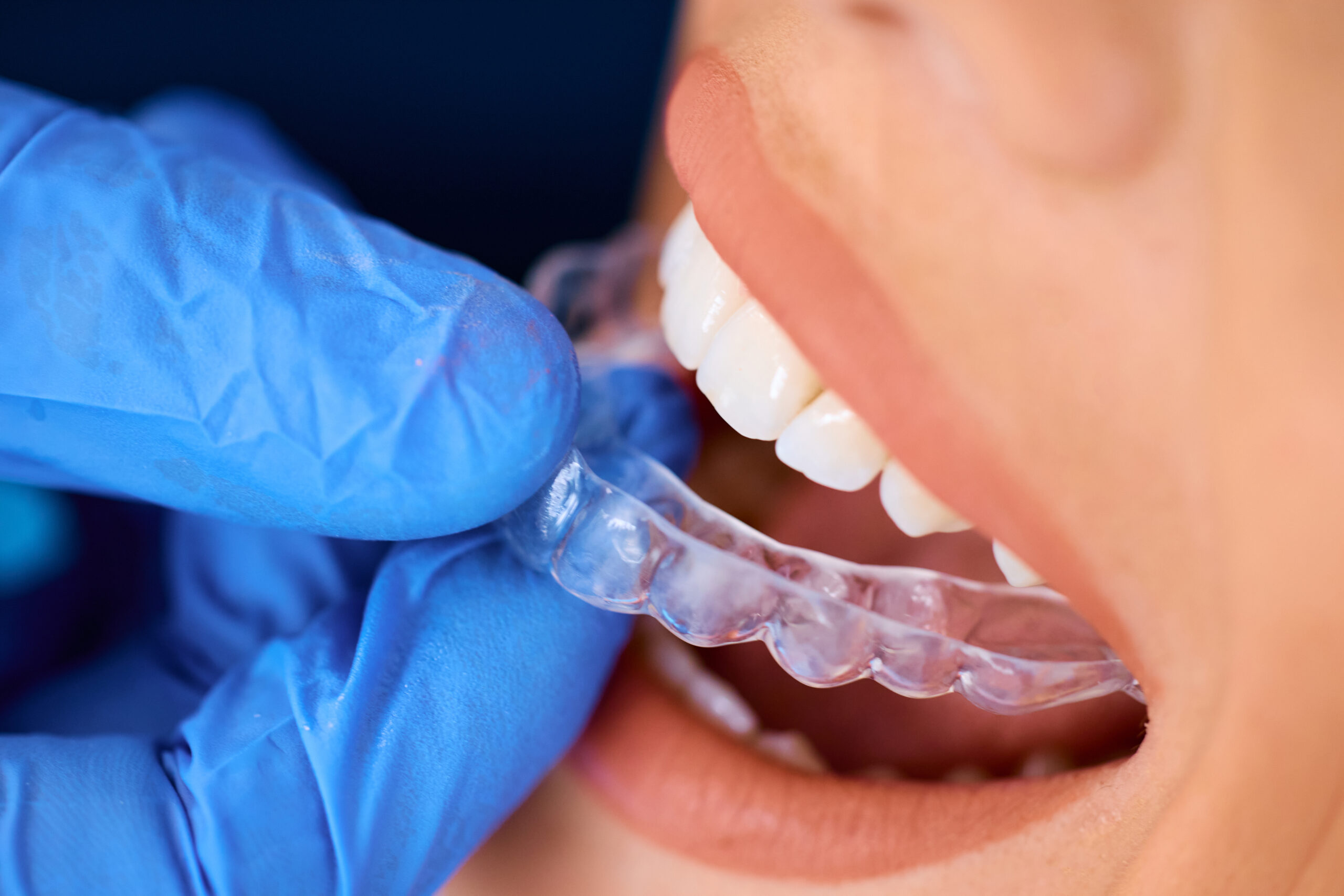 Invisalign for teens Glen Allen