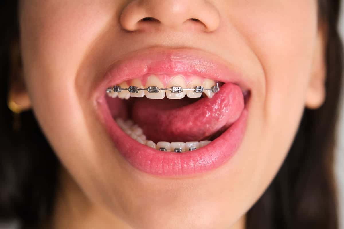 Braces in Short Pump