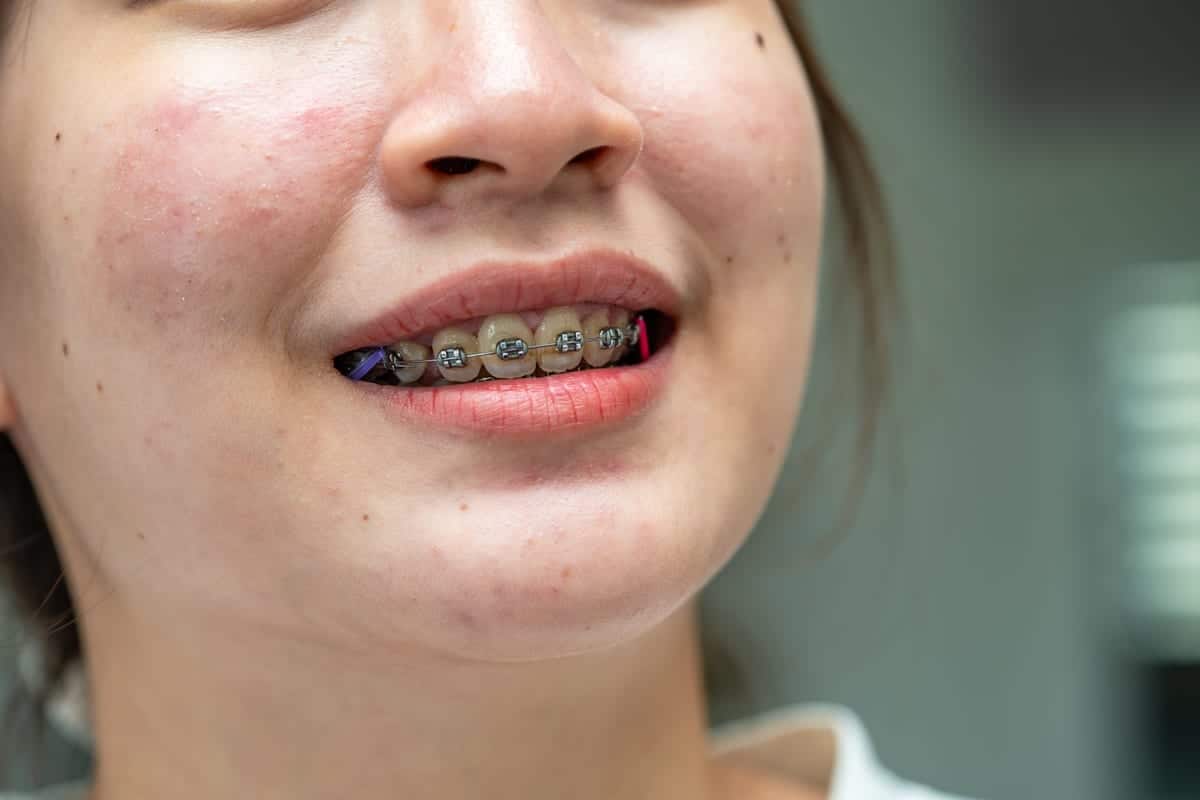 Braces in Glen Allen